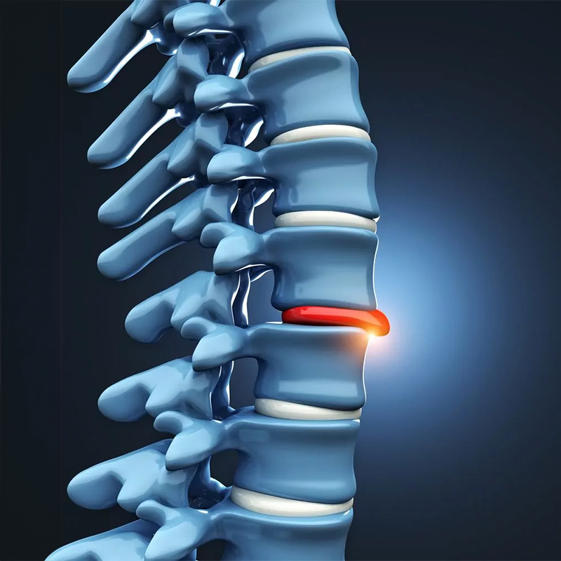 Spinal Cord Injury Lawyer in Orlando