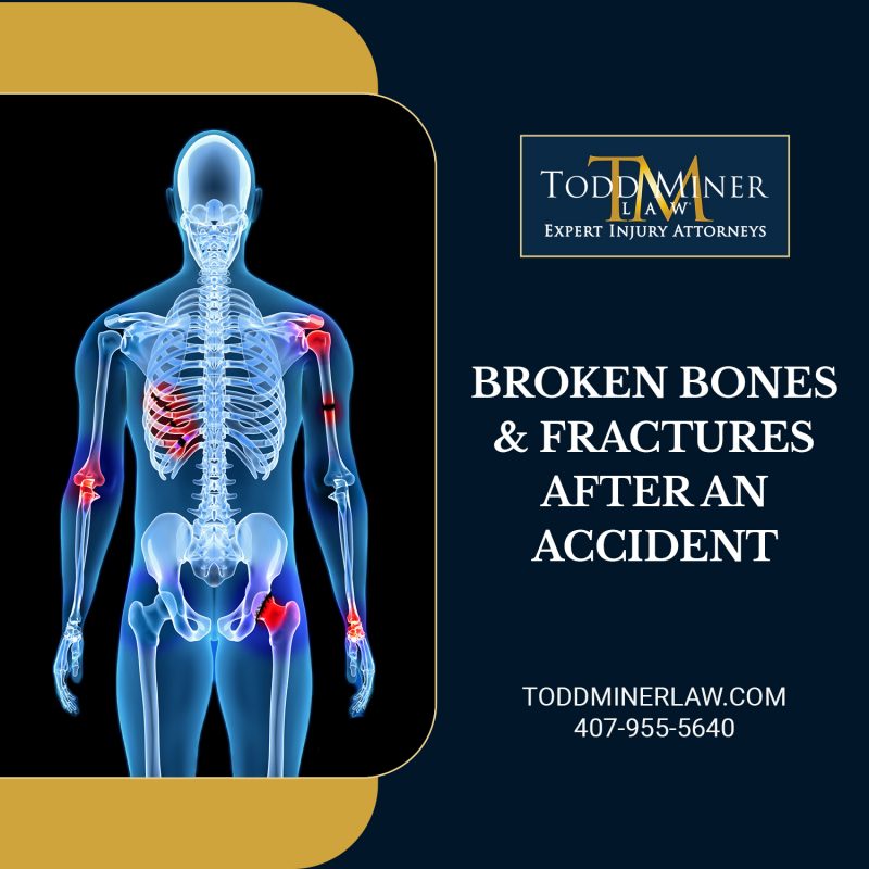 Broken Bones and Fractures After an Accident