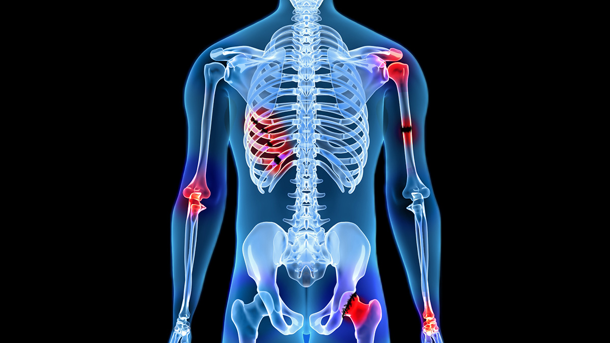 Broken Bones and Fractures After an Accident